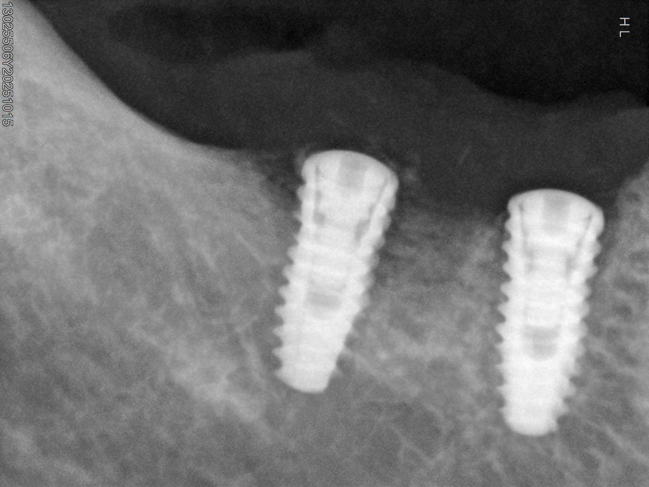 2 implantes