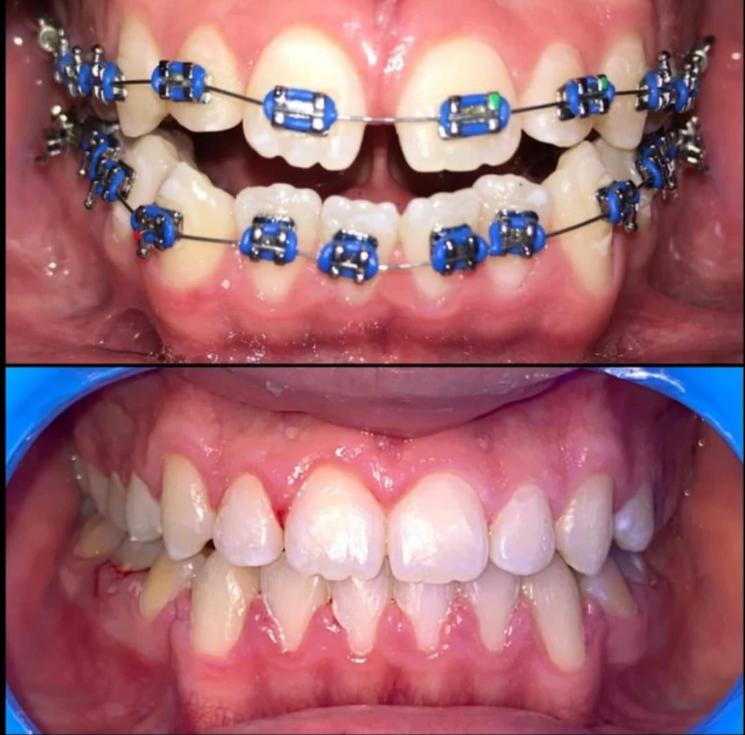 alineacion con brackets