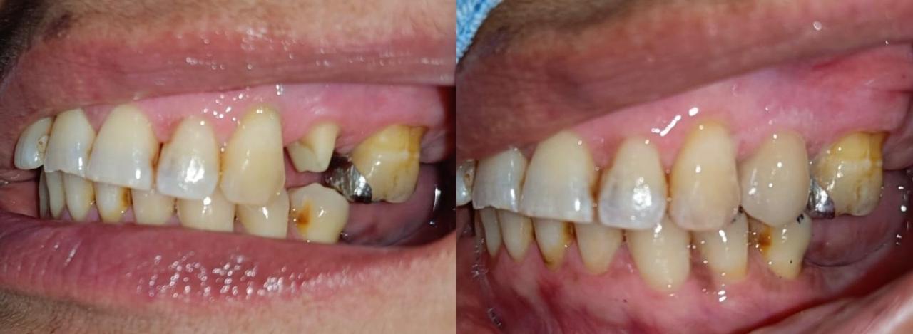 corona dental