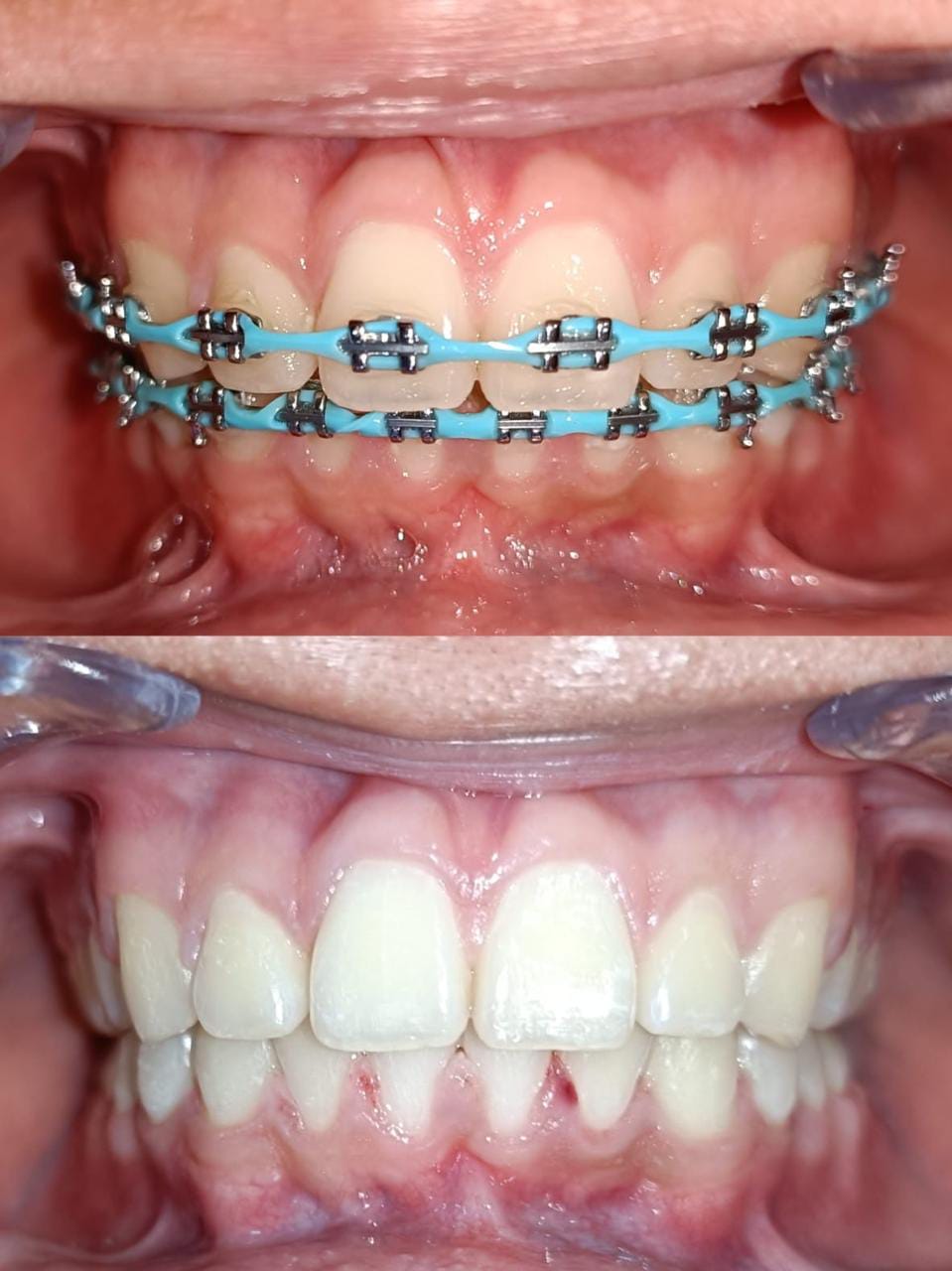 dientes alineados