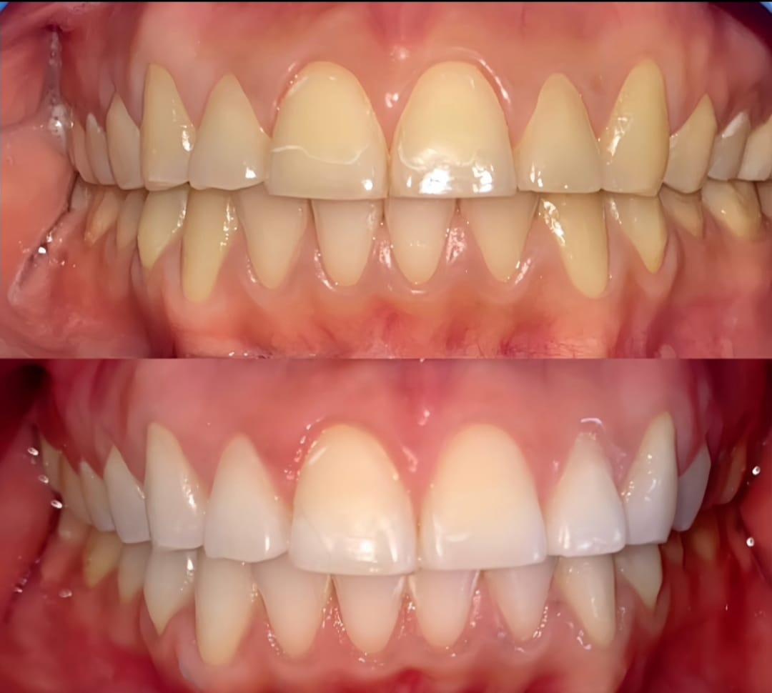 dientes blacos y alineados
