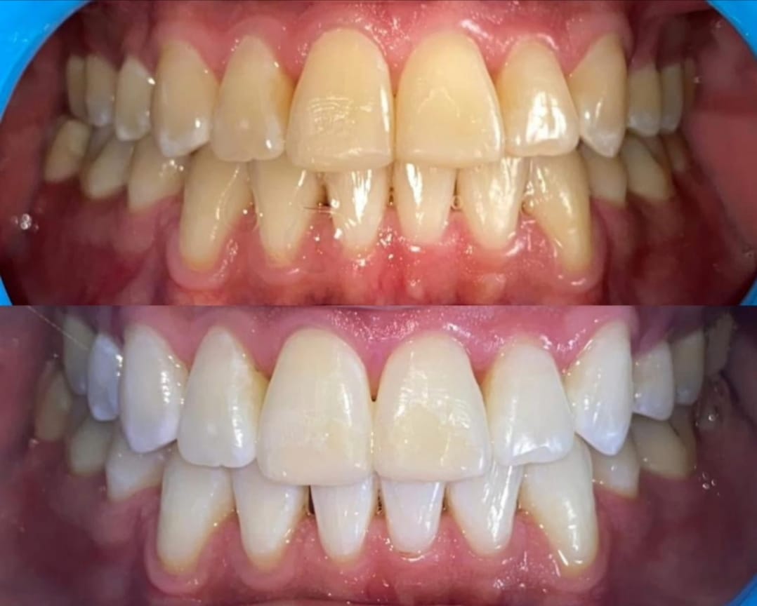 dientes blancos