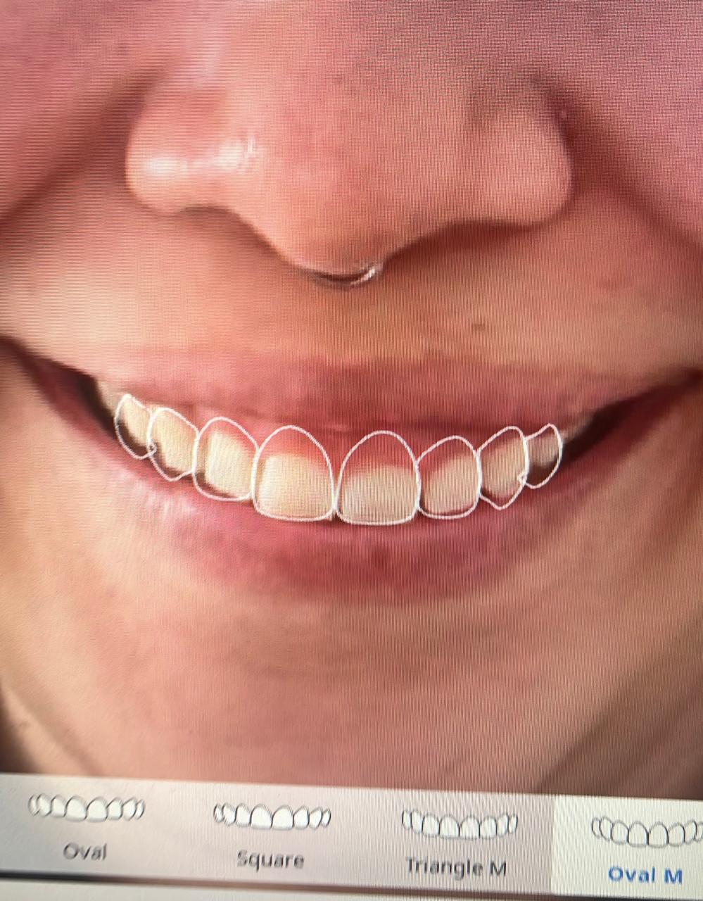 diseño de sonrisa
