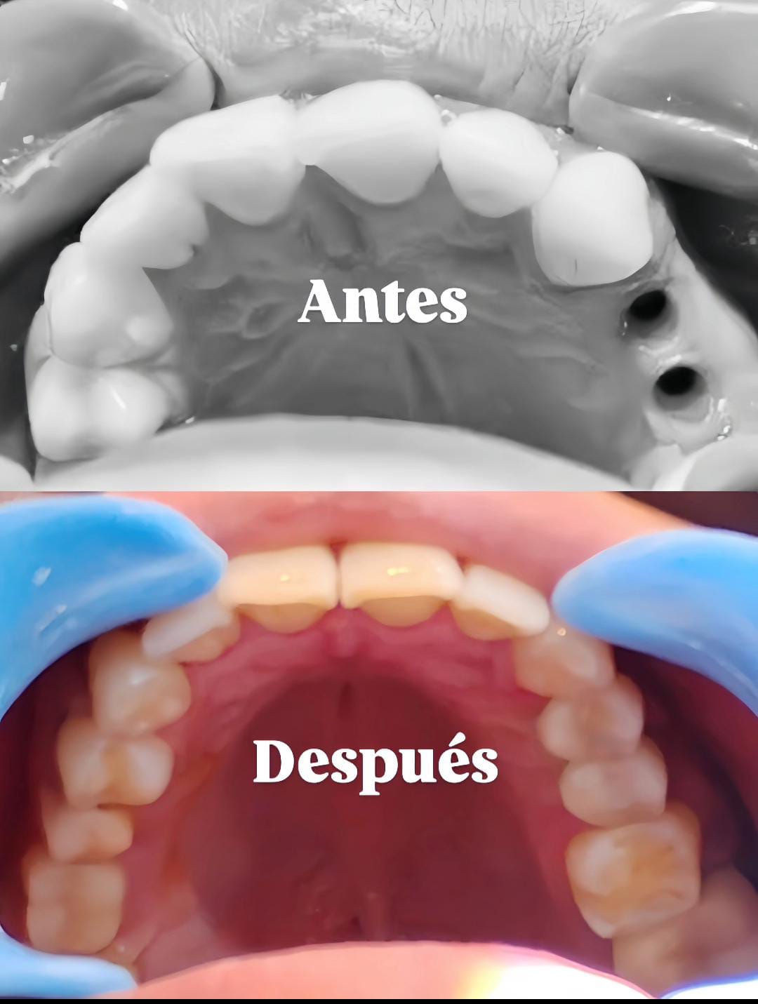 implante molares
