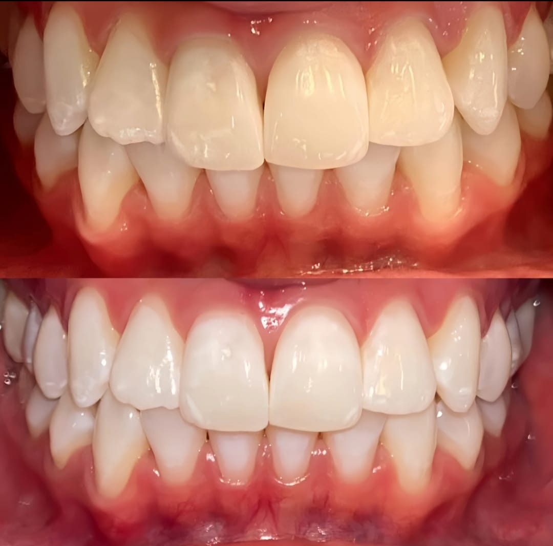 limpieza de dientes
