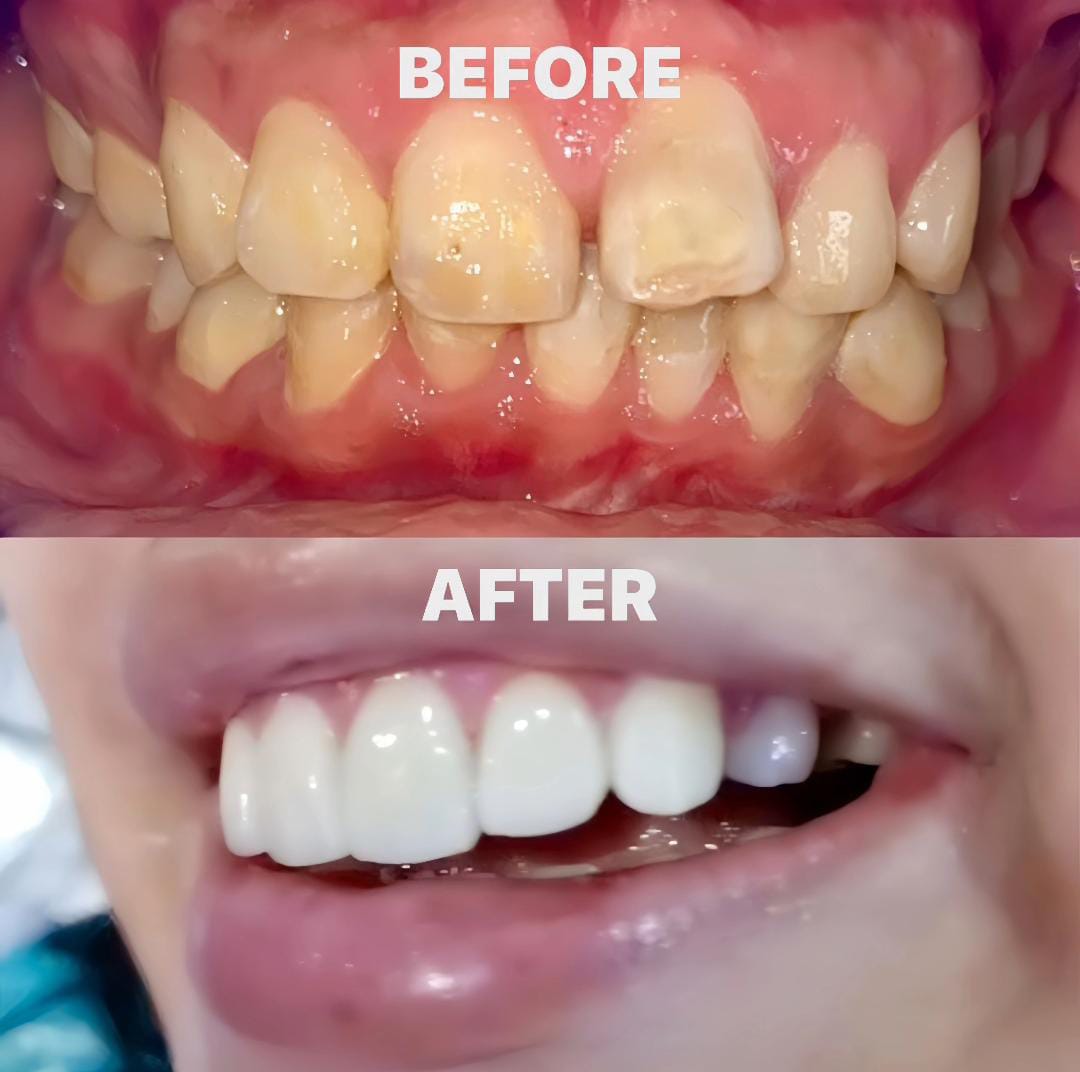sonrisa dientes blancos